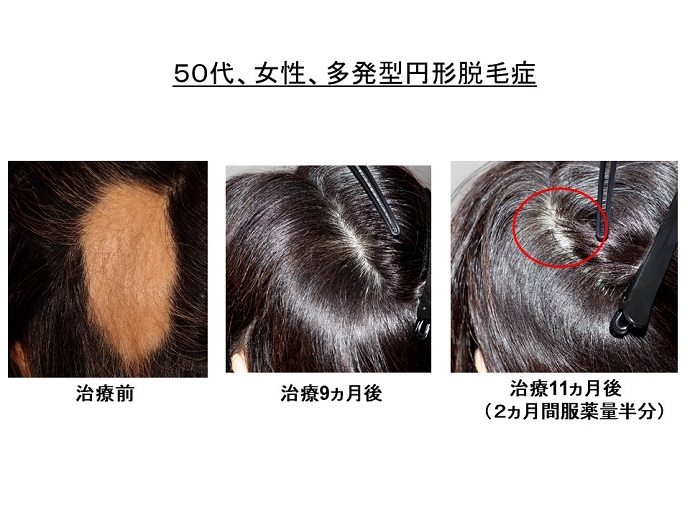 円形脱毛症　病院